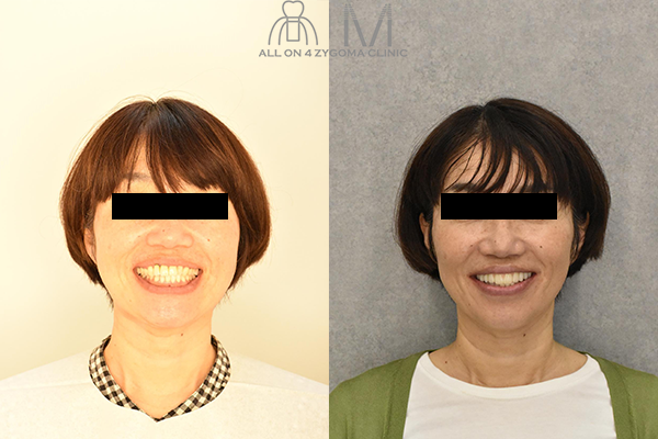 zygoma case